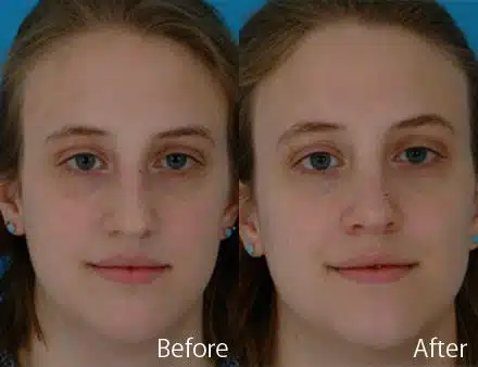 Nasal Bump Before and After Photos in Sewell, NJ, Patient 7340