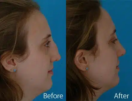 Nasal Bump Before and After Photos in Sewell, NJ, Patient 7340