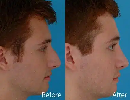 Nasal Bump Before and After Photos in Sewell, NJ, Patient 7361