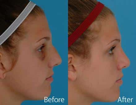 Nasal Bump Before and After Photos in Sewell, NJ, Patient 7363