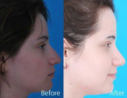 Nasal Bump Before and After Photos in Sewell, NJ, Patient 7365