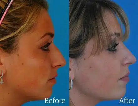 Nasal Bump Before and After Photos in Sewell, NJ, Patient 7367