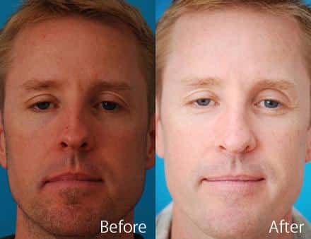 Nasal Bump Before and After Photos in Sewell, NJ, Patient 7369