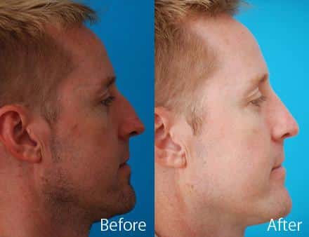 Nasal Bump Before and After Photos in Sewell, NJ, Patient 7369