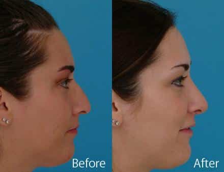 Nasal Bump Before and After Photos in Sewell, NJ, Patient 7372