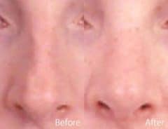 Narrow Nose Before and After Photos in Sewell, NJ, Patient 7397