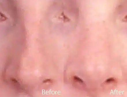 Narrow Nose Before and After Photos in Sewell, NJ