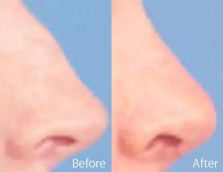 Narrow Nose Before and After Photos in Sewell, NJ, Patient 7397