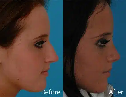 Overprojected Before and After Photos in Sewell, NJ, Patient 7441