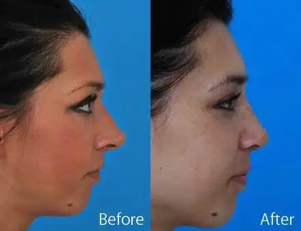 Overprojected Before and After Photos in Sewell, NJ, Patient 7443