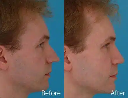 Overprojected Before and After Photos in Sewell, NJ, Patient 7445