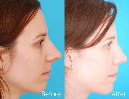 Overprojected Before and After Photos in Sewell, NJ, Patient 7447