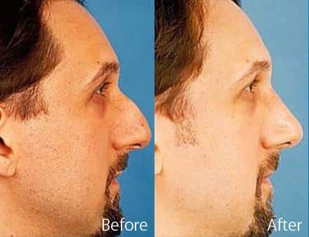 Overprojected Before and After Photos in Sewell, NJ, Patient 7452