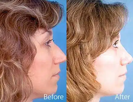 Overprojected Before and After Photos in Sewell, NJ, Patient 7454