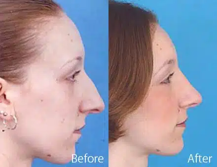 Overprojected Before and After Photos in Sewell, NJ, Patient 7456