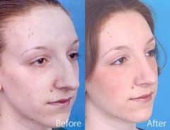 Overprojected Before and After Photos in Sewell, NJ, Patient 7456