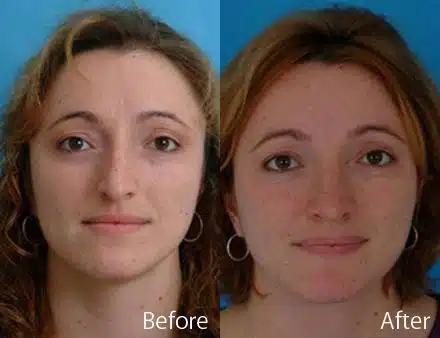 Overprojected Before and After Photos in Sewell, NJ, Patient 7461