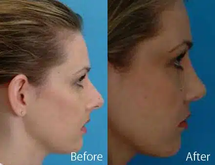 Overprojected Before and After Photos in Sewell, NJ, Patient 7464