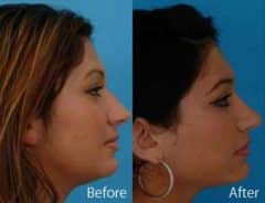 Overprojected Before and After Photos in Sewell, NJ, Patient 7466