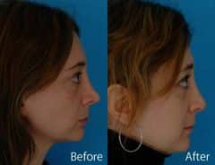 Overprojected Before and After Photos in Sewell, NJ, Patient 7468