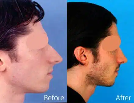 Overprojected Before and After Photos in Sewell, NJ, Patient 7470