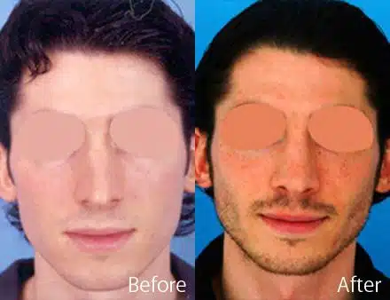 Overprojected Before and After Photos in Sewell, NJ, Patient 7470