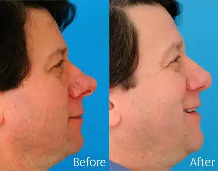 Overprojected Before and After Photos in Sewell, NJ, Patient 7473