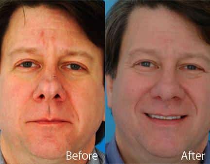 Overprojected Before and After Photos in Sewell, NJ, Patient 7473