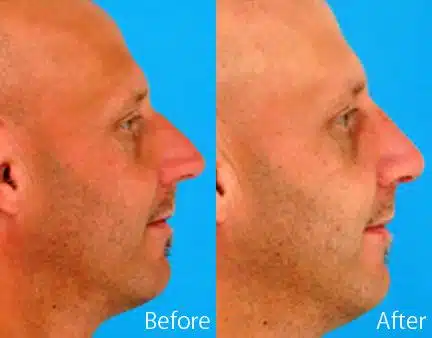 Overprojected Before and After Photos in Sewell, NJ, Patient 7476