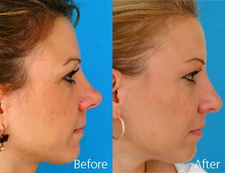 Overprojected Before and After Photos in Sewell, NJ, Patient 7482