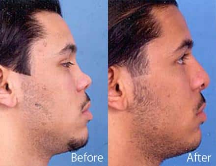 Revision Rhinoplasty Before and After Photos in Sewell, NJ, Patient 7524