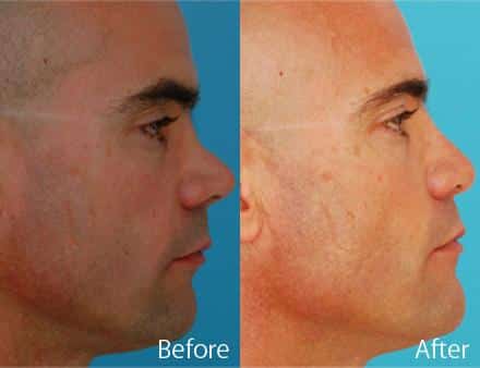 Revision Rhinoplasty Before and After Photos in Sewell, NJ, Patient 7526