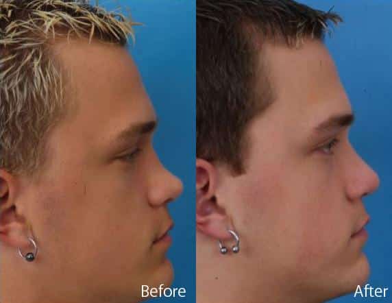 Revision Rhinoplasty Before and After Photos in Sewell, NJ, Patient 7532