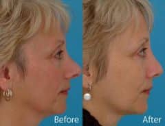 Revision Rhinoplasty Before and After Photos in Sewell, NJ, Patient 7535