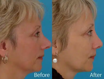 Revision Rhinoplasty Before and After Photos in Sewell, NJ, Patient 7535