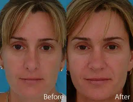 Revision Rhinoplasty Before and After Photos in Sewell, NJ, Patient 7537