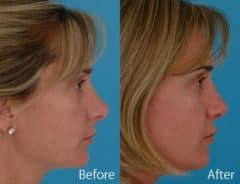 Revision Rhinoplasty Before and After Photos in Sewell, NJ, Patient 7537