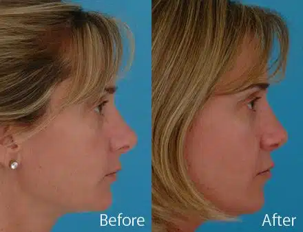 Revision Rhinoplasty Before and After Photos in Sewell, NJ, Patient 7537