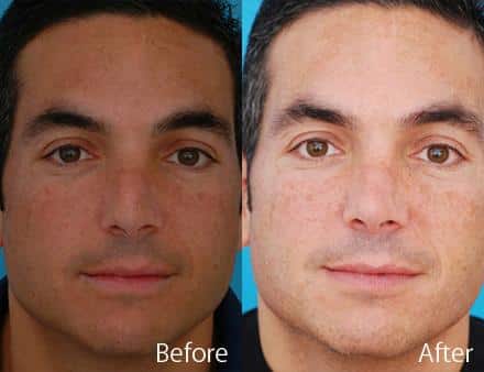 Revision Rhinoplasty Before and After Photos in Sewell, NJ, Patient 7540