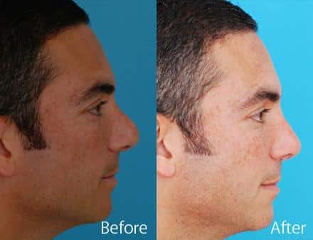 Revision Rhinoplasty Before and After Photos in Sewell, NJ, Patient 7540