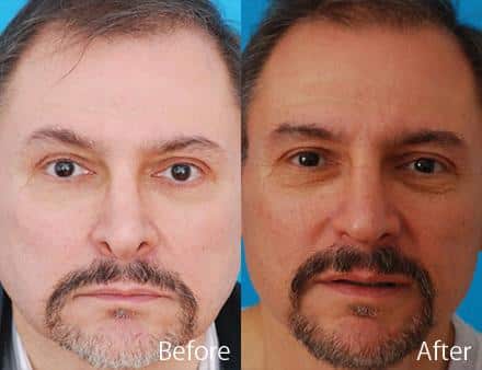 Revision Rhinoplasty Before and After Photos in Sewell, NJ, Patient 7594