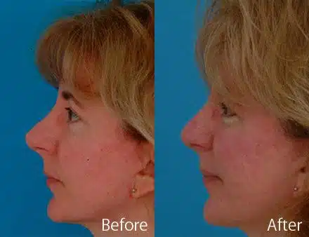 Revision Rhinoplasty Before and After Photos in Sewell, NJ, Patient 7597