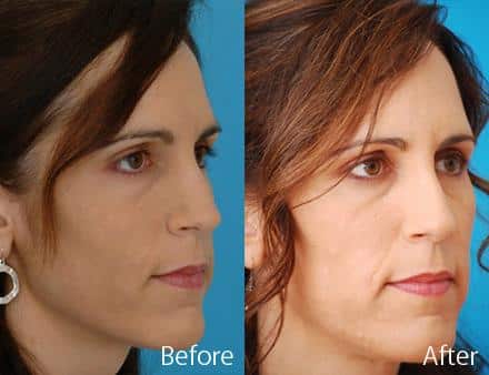 Revision Rhinoplasty Before and After Photos in Sewell, NJ, Patient 7600