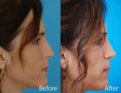 Revision Rhinoplasty Before and After Photos in Sewell, NJ, Patient 7600