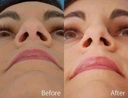 Revision Rhinoplasty Before and After Photos in Sewell, NJ, Patient 7600