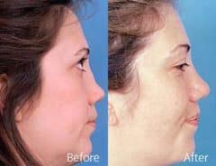 Revision Rhinoplasty Before and After Photos in Sewell, NJ, Patient 7605