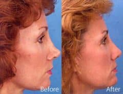 Revision Rhinoplasty Before and After Photos in Sewell, NJ, Patient 7607