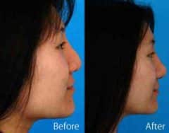 Revision Rhinoplasty Before and After Photos in Sewell, NJ, Patient 7612