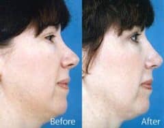 Revision Rhinoplasty Before and After Photos in Sewell, NJ, Patient 7614