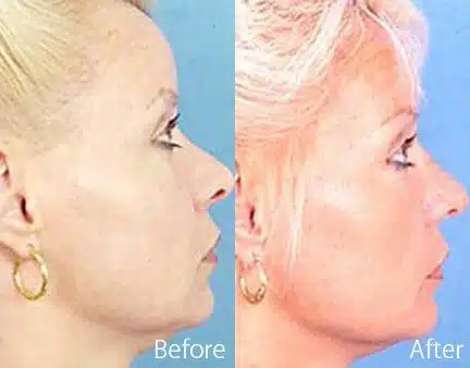 Revision Rhinoplasty Before and After Photos in Sewell, NJ, Patient 7617